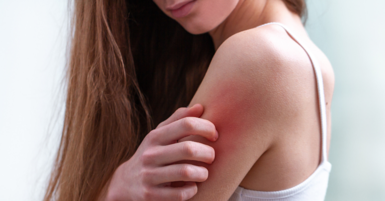 Understanding TCM Remedies for Eczema in Singapore: What You Need to Know